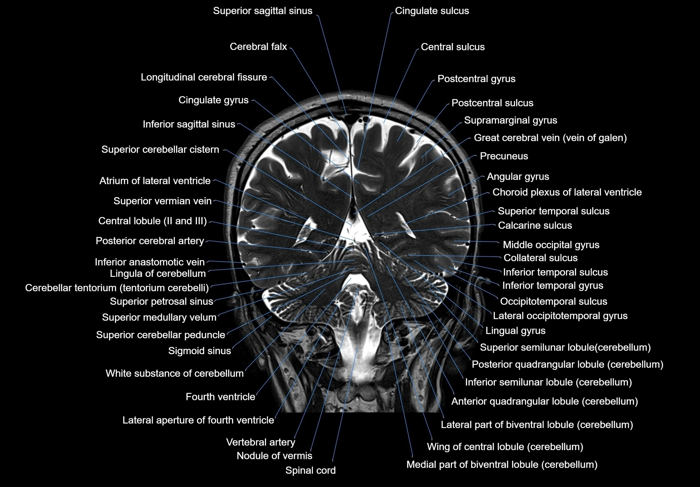 MRI Brain coronal cross sectional labelled anatomy 3T image  -img-00001-00051.webp